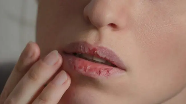 Cara mengatasi bibir kering saat puasa